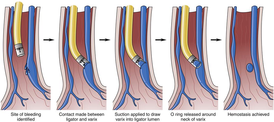 Кровотечение варикозных вен. Что такое легирование ВРВ пищевода. Варикозно-расширенные вены пищевода лигирование. Лигирование вены пищевода что такое. Лигирование ВРВ пищевода.