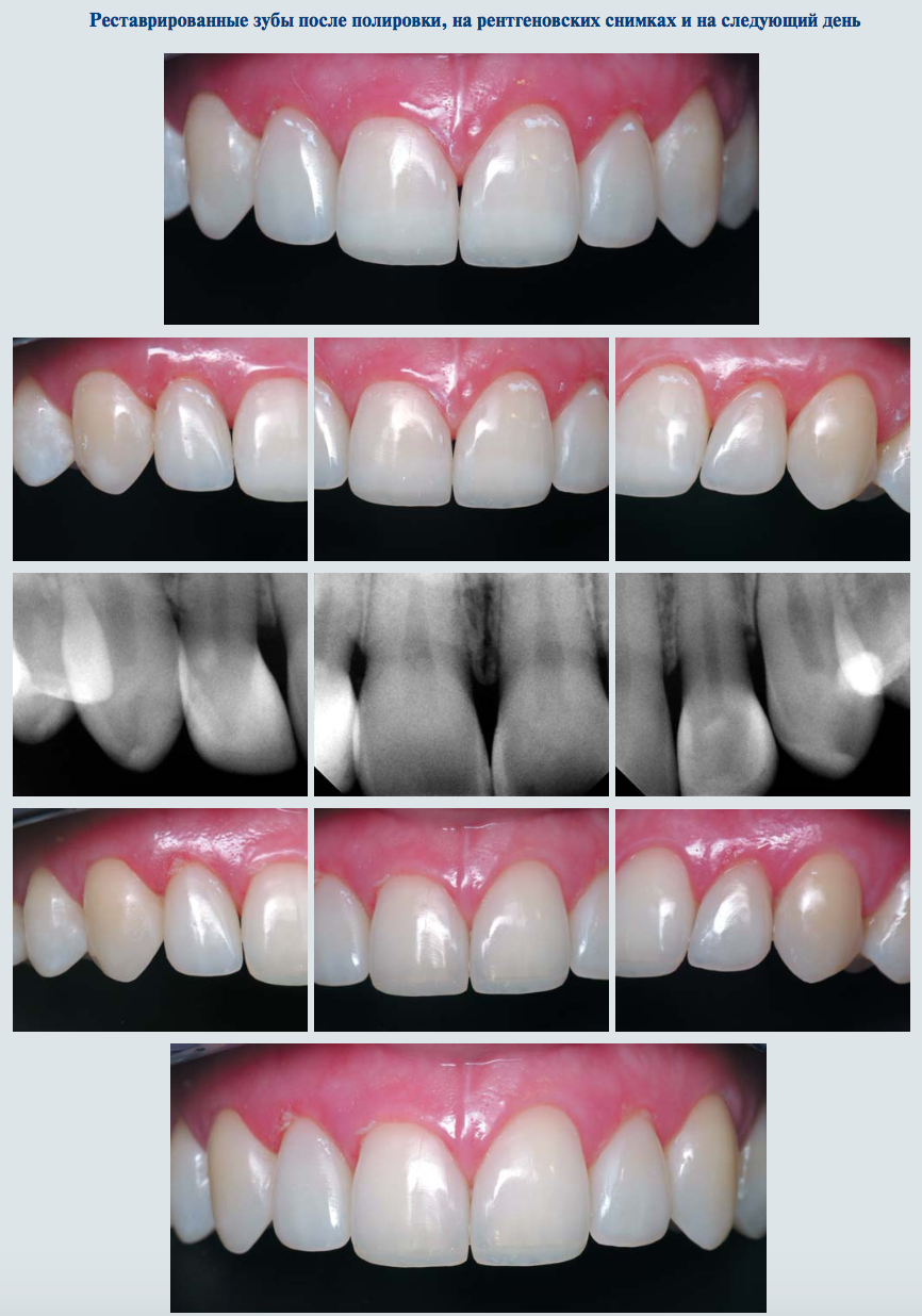 Композитные виниры кариес. Восстановление формы зуба. Художественное наращивание зубов. Изгиб зубов