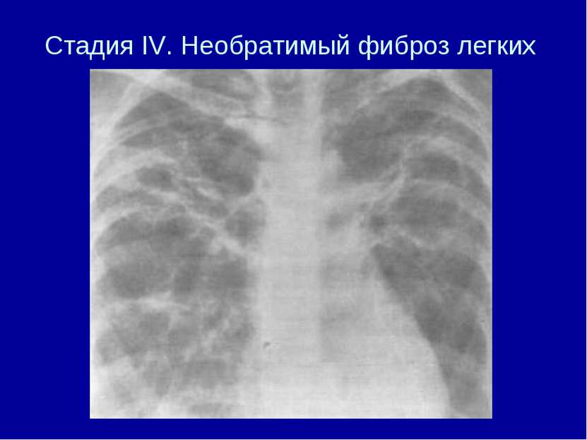 Фиброз легких это. Паракостальный фиброз это. Линейный фиброз легких рентген. Периспондилофитарный фиброз.