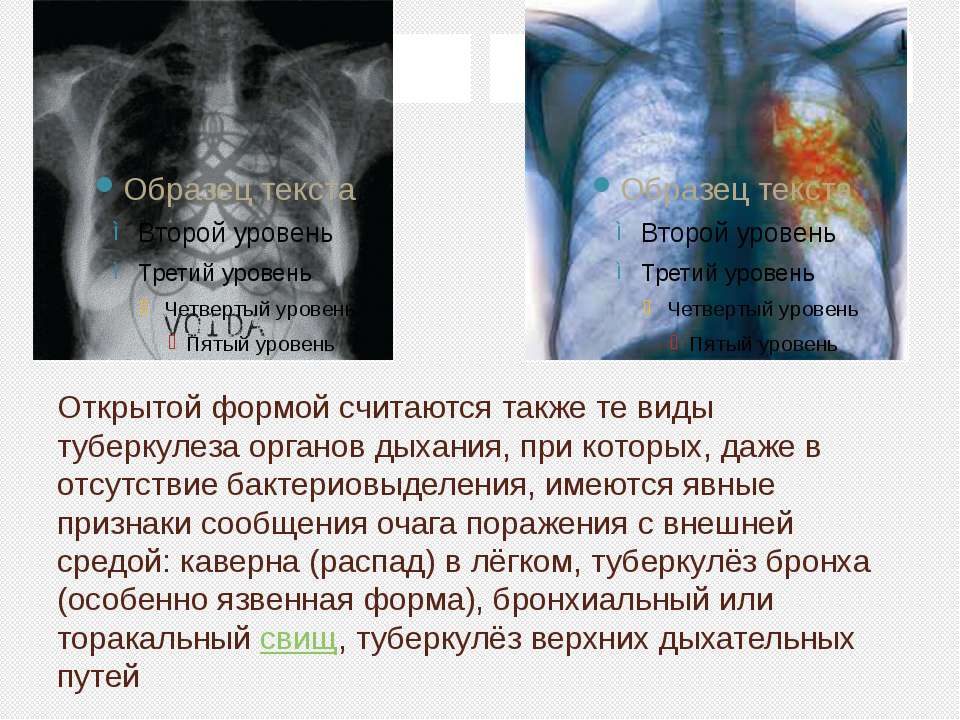 Причины туберкулеза. Туберкулез органов дыхания презентация. Туберкулез и курение презентация. Формы туберкулеза органов дыхания. Презентация на тему туберкулёз дыхательных путей.