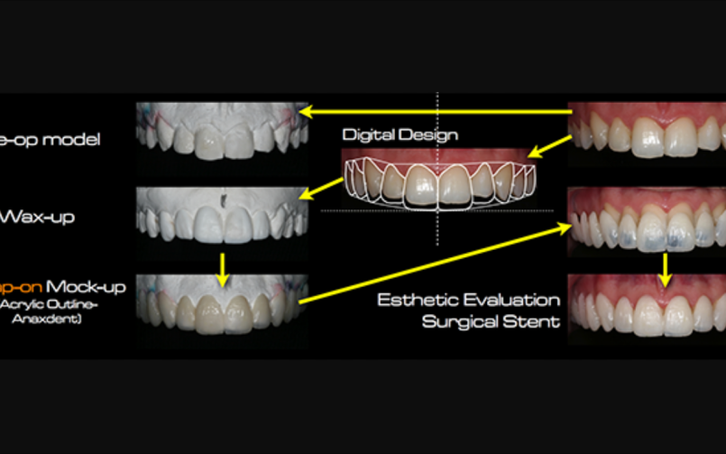 Мокап стоматология. Технология Mock up в стоматологии.