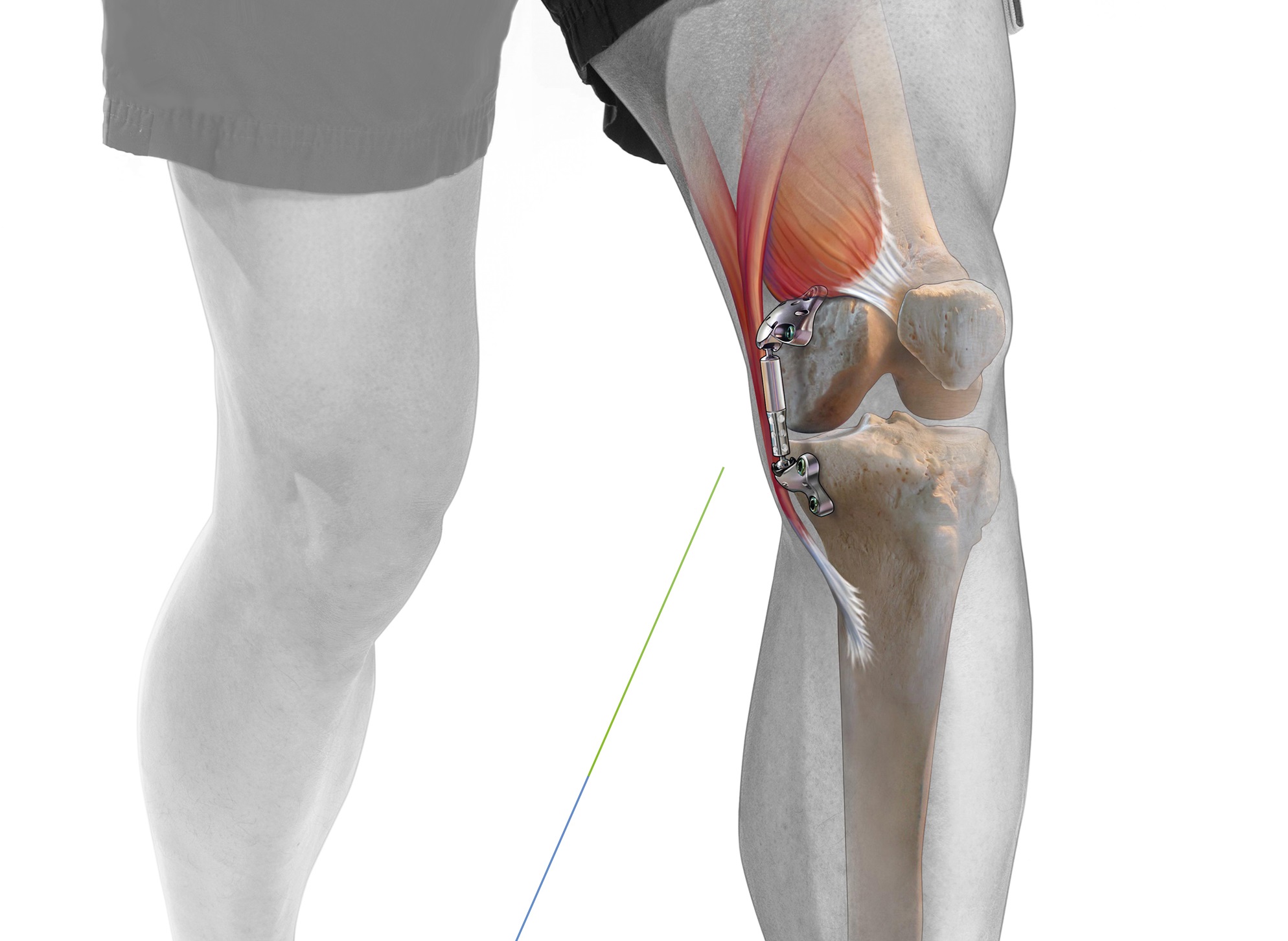 Почему колено после эндопротезирования. Эндопротез коленного сустава. Деформирующий остеоартроз коленного сустава эндопротез. Титановый эндопротез коленный. Эндопротезирование ортопедической коленного сустава PFC Sigma CR allpoly.