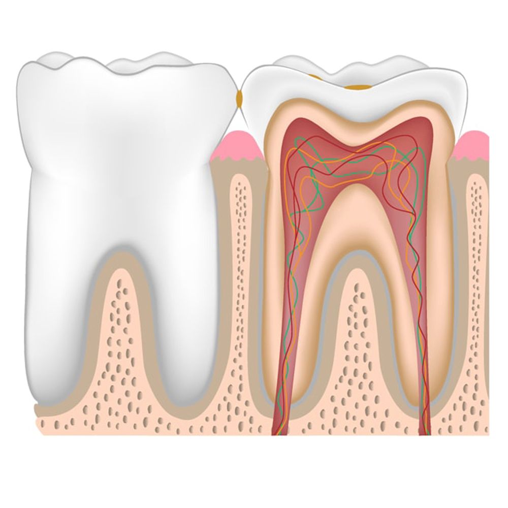 Осложнение лечения периодонтита. Пульпит периодонтит зубов. Кариес пульпит периодонтит.