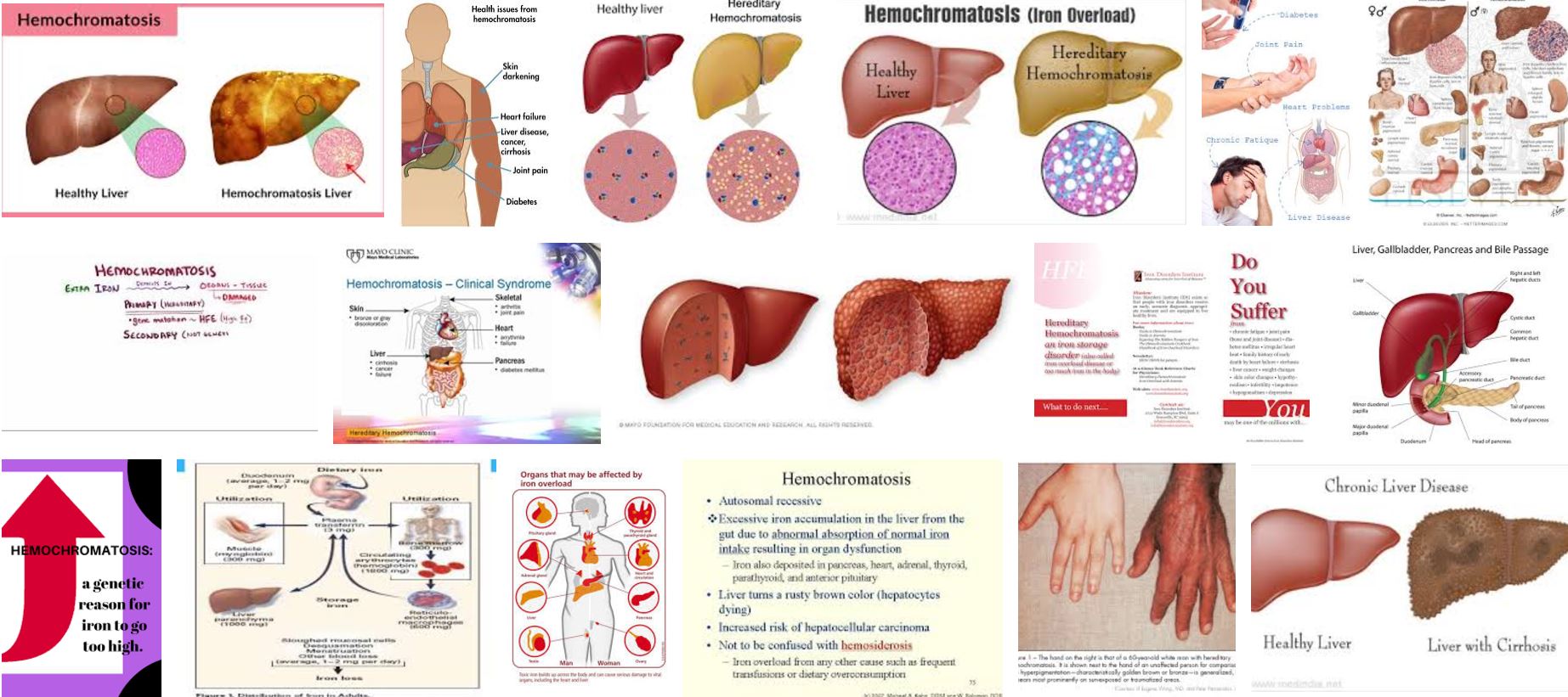 Гемохроматоз симптомы. Наследственный гемохроматоз. Гемохроматоз кожные проявления.