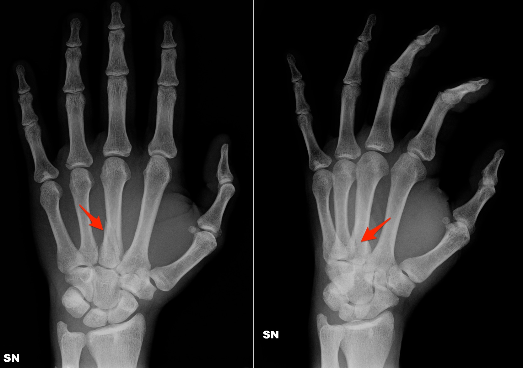 Как определить трещину в кости. Перелом проксимальной фаланги 1 пальца кисти рентген. Периостит пальца кисти рентген. Перелом пястной кости мизинца. Перелом основания 2 пястной кости.