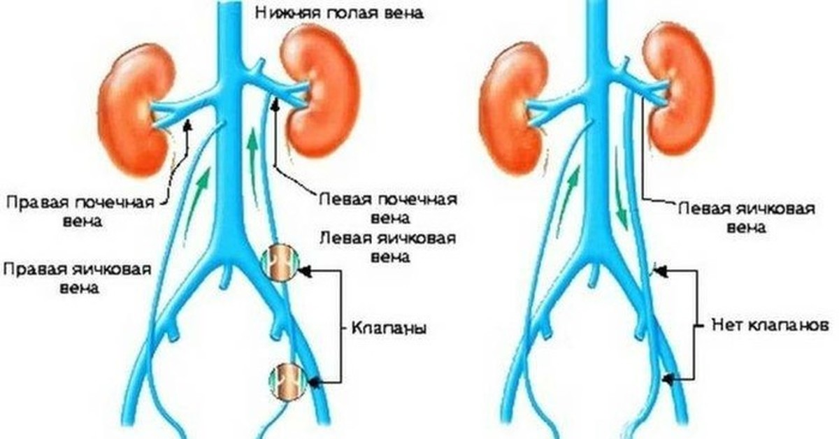 Варикозное расширение вен семенного канатика на