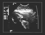 ultrasound of baby