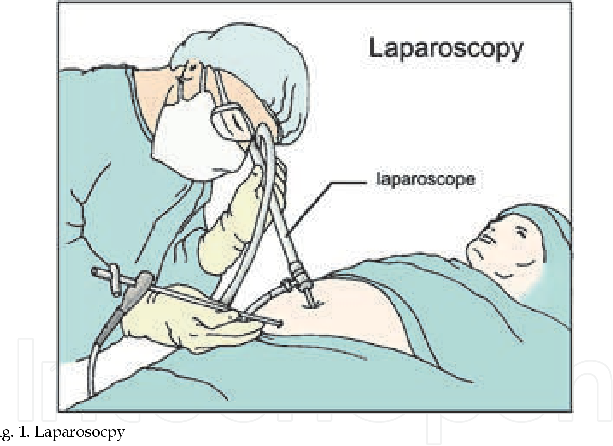 Нельзя проводить операцию. Лапароскопическая аппендэктомия лапароскопия. Лапароскопия после операции. Лапароскопия аппендицита. Лапароскопия брюшной полости.