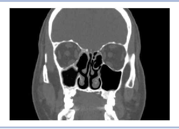 Кт околоносовых пазух фото