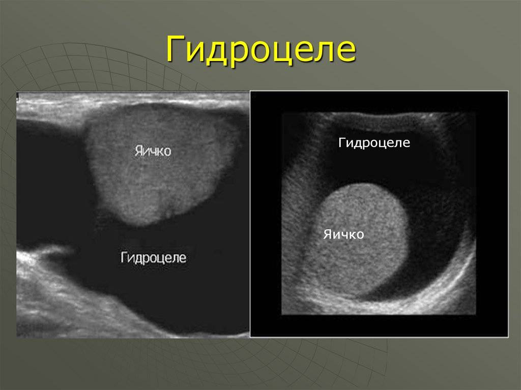 Узи яичек у ребенка. Гидроцеле осумкованное. Водянка оболочек яичка. Сообщающаяся водянка оболочек яичка.
