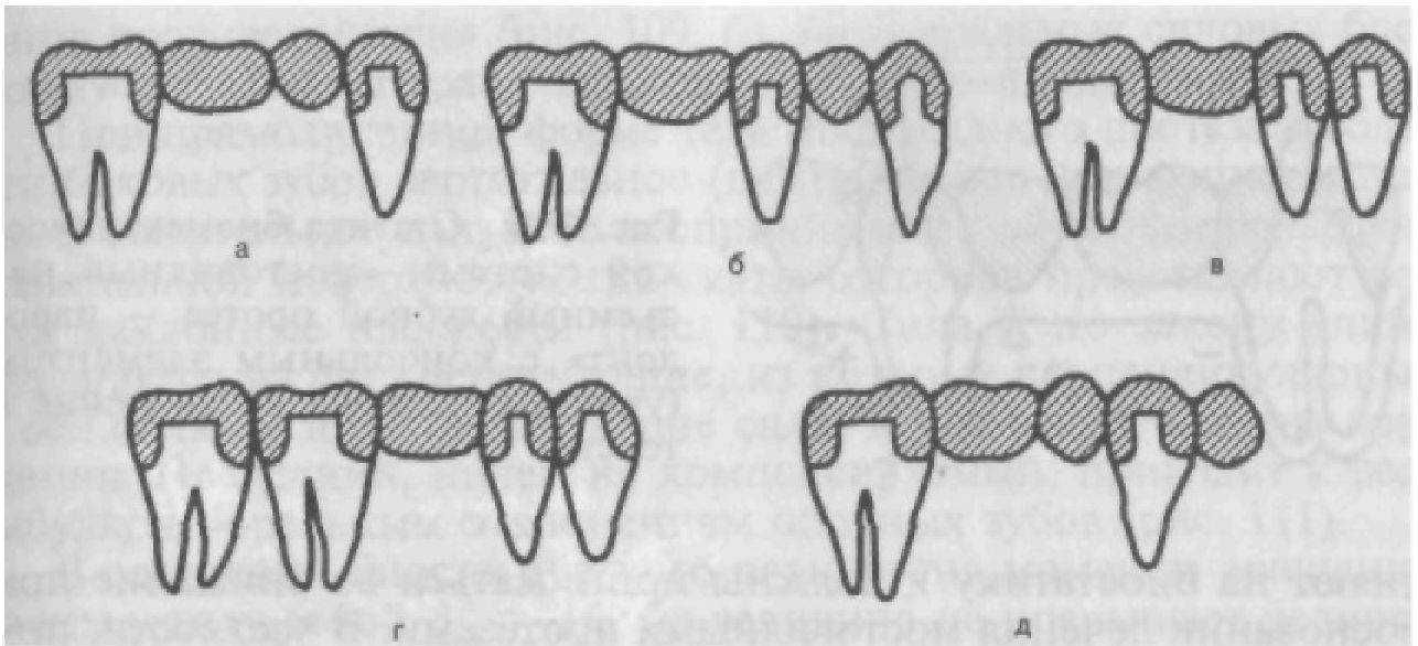 Виды мостовидных протезов. Седловидная форма мостовидного протеза. Мостовидный протез с опорой на 2 зуба. Типы промежуточной части мостовидного протеза. Формы промежуточной части мостовидного протеза.