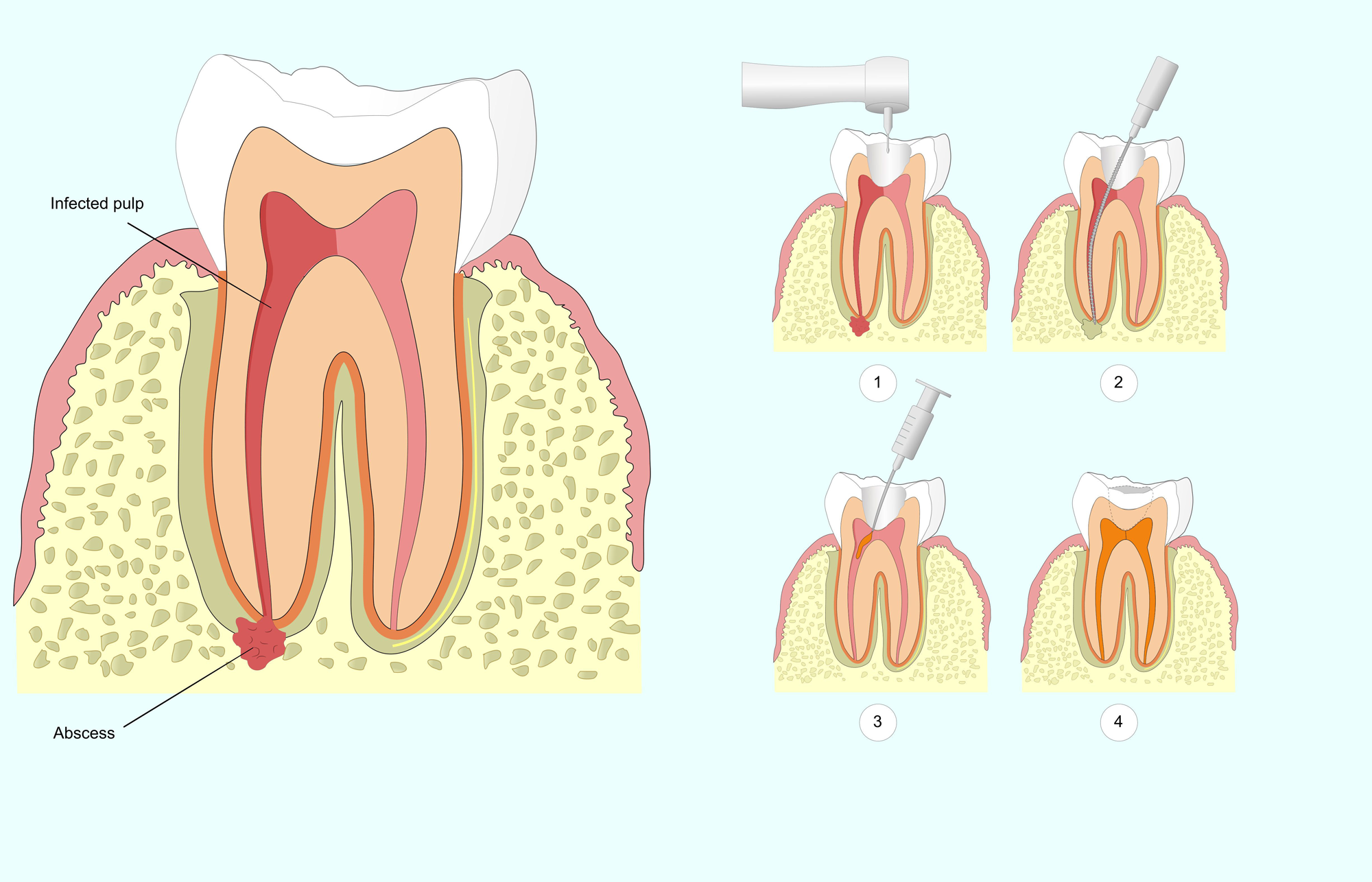 Температура после лечения зуба. Зубы абсцесс абсцесс зуба. Подкожная гранулема зуба. Межкорневая гранулема.