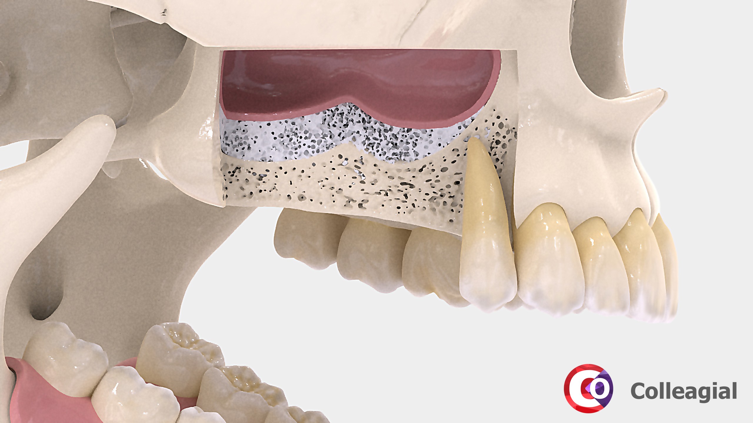 Зуб без кости. Синус-лифтинг (костная пластика, остеопластика). Синус-лифтинг (костная пластика, остеопластика) закрытый. Синус-лифтинг (Bio-oss 1 грамм).