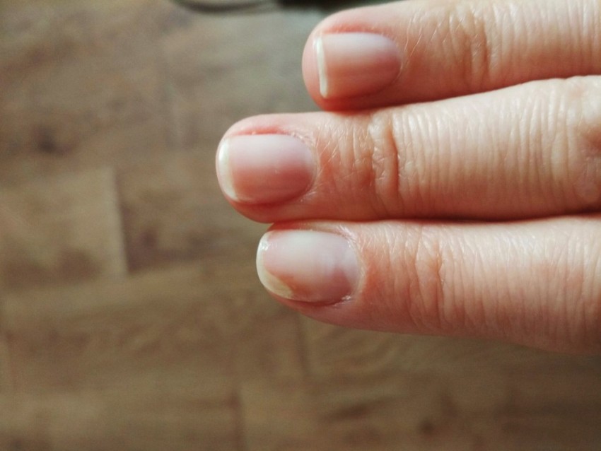 Онихолизис ногтей на руках фото чем лечить