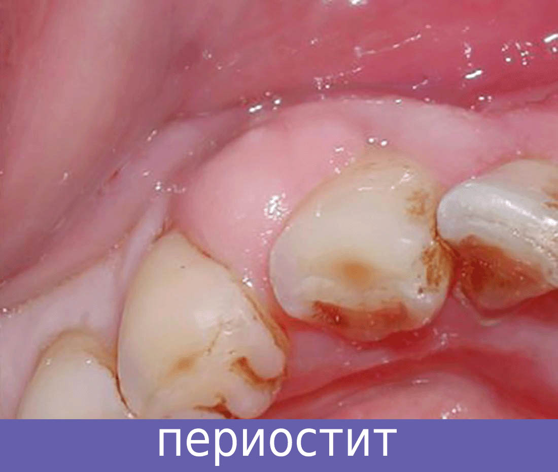 флюс у ребенка - периостит