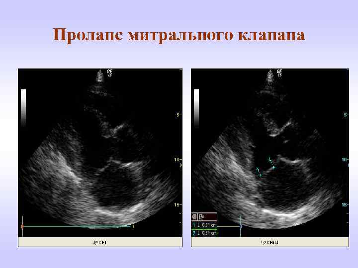 Как лечить пролапс митрального клапана