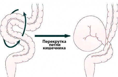 Расширение петель кишечника. Лишняя петля в сигмовидной кишке. Сигмовидная петля кишечника. Дополнительная петля Толстого кишечника у детей.