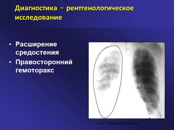 Гемоторакс клиническая картина