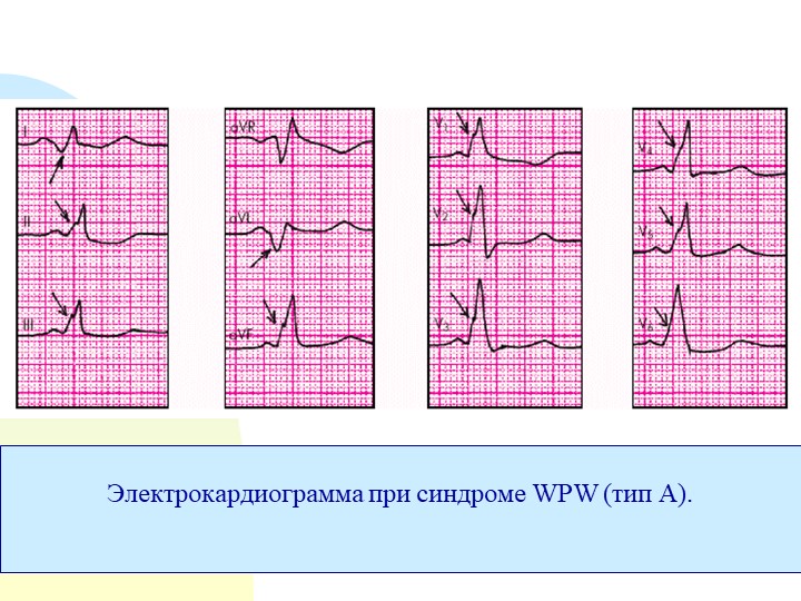 Wpw синдром на экг фото