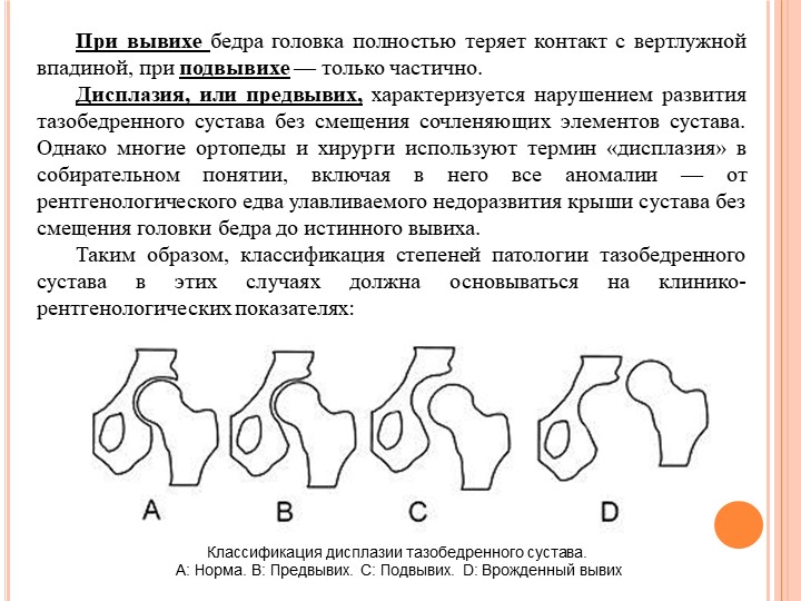 Врожденный вывих бедра