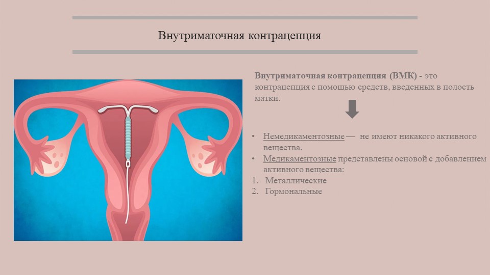 Спираль от беременности минусы. Внутриматочные контрацептивы (ВМК). Внутриматочный метод контрацептива. Внутриматочная контрацепция метод контрацепции. Внутриматочная спираль методы контрацептивов.