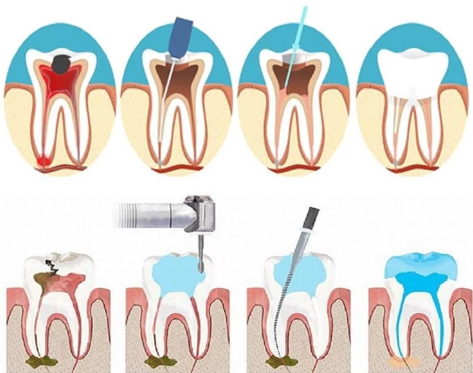 После эндодонтического лечения. 4 Канальный пульпит зуба. Этапы пломбирования корневых каналов.