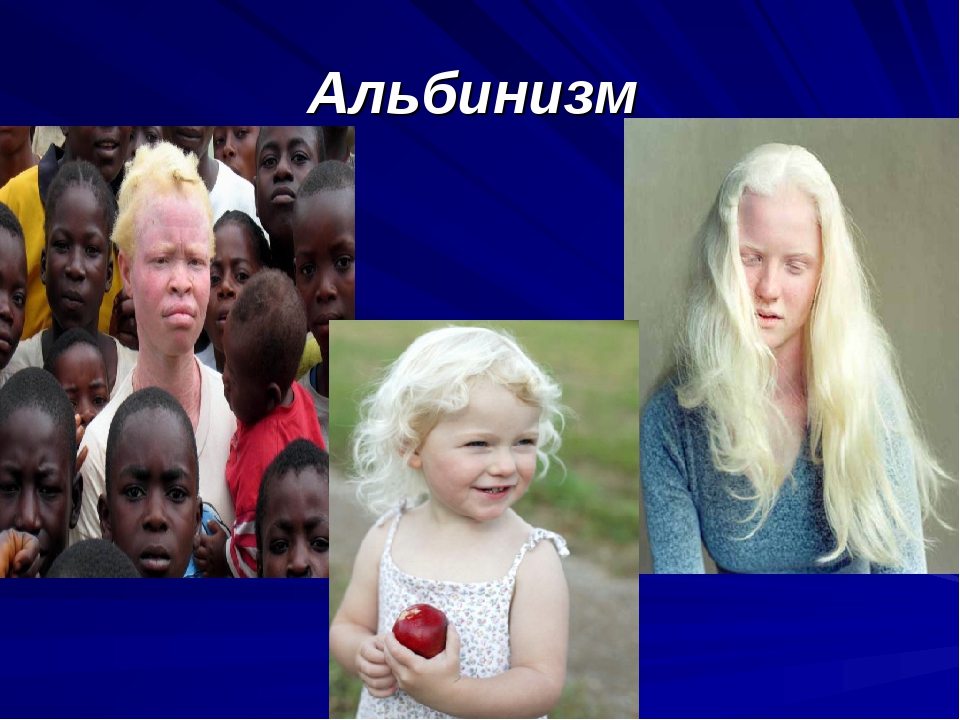 Альбинизм 1в. Наследственная болезнь альбинизм. Клинические симптомы альбинизма. Генетические заболевания альбинизм. Альбинизмом страдают