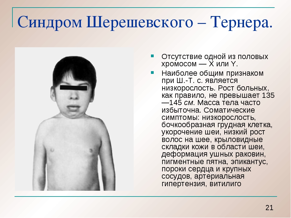 Синдром тернера какая хромосома. СИНДРОМШЕРЕШЕВСКОГО-Тёрнера. Синдром Тернера хромосомы.
