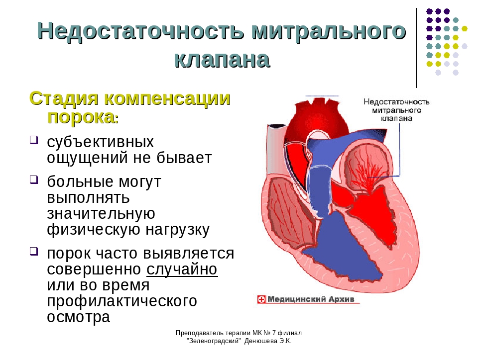 Сердечная недостаточность митрального клапана. Порок митрального клапана сердца. Недостаточность митрального клапана сердца. Недостаточность митрального клапана структура. Митральный стеноз сердца гемодинамика.