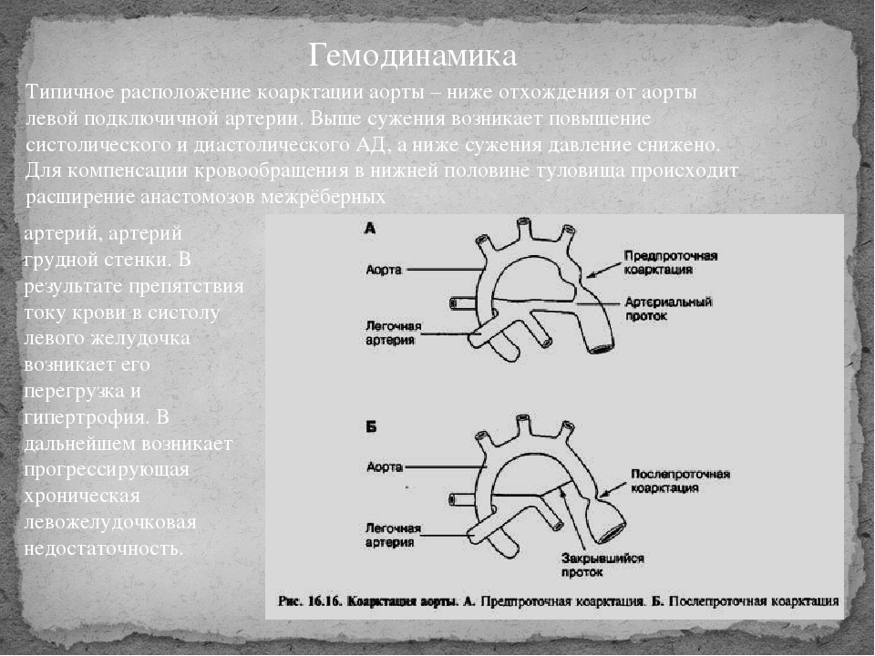 Коарктация аорты презентация