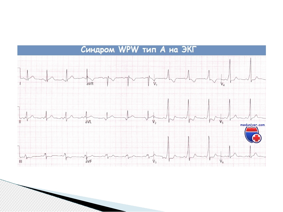Впв расшифровка. Заключение ЭКГ при wpw. ВПВ синдром ЭКГ заключение. Синдром wpw Тип а на ЭКГ. Синдром ВПВ сердца на ЭКГ.