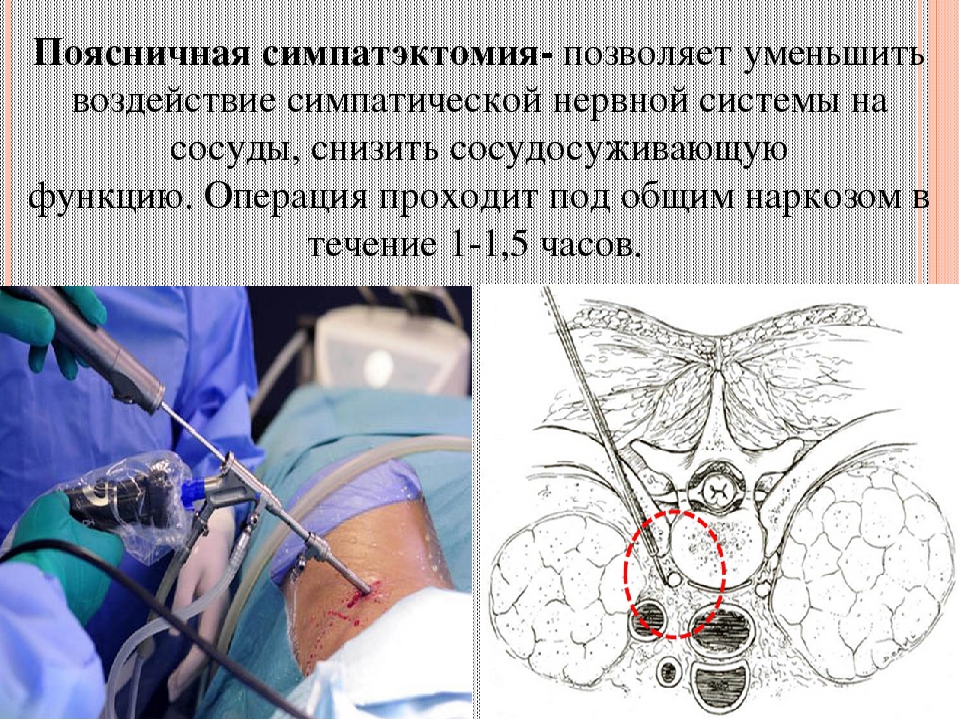 Операция под общим. Периартериальная симпатэктомия. Торакоскопическая симпатэктомия. Поясничная симпатэктомия ход операции. Периартериальная симпатэктомия по Леришу.