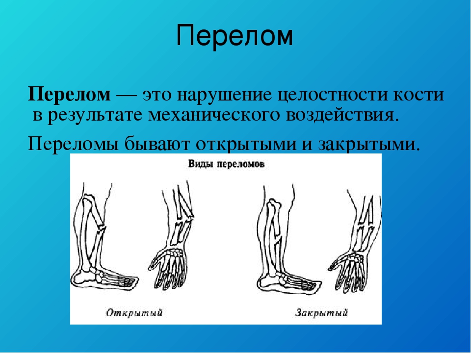 Закрытый перелом симптомы. Переломы бывают открытые закрытые.