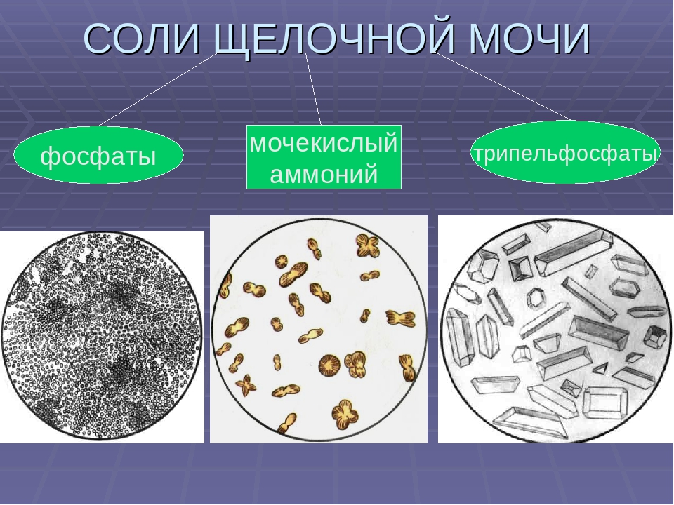 Высокая соль в моче. Микроскопия осадка мочи трипельфосфаты. Фосфаты в моче микроскопия. Микроскопия мочи трипельфосфаты. Соли в моче.