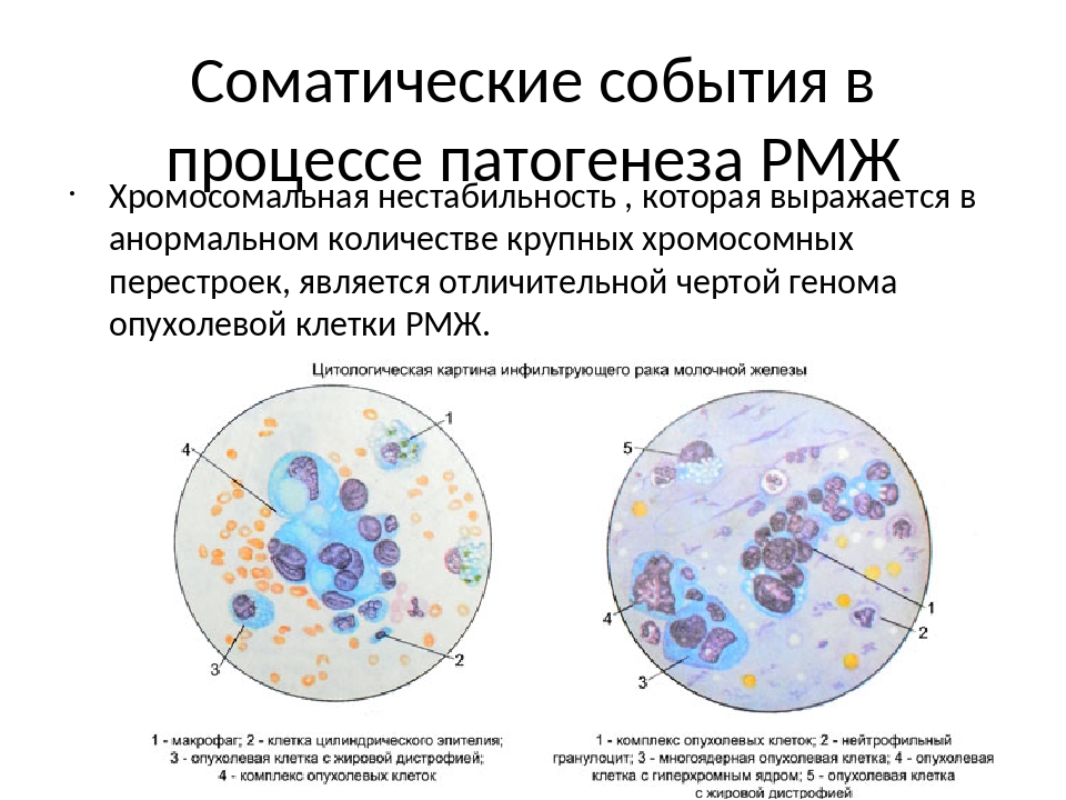 Гормонозависимый рак груди