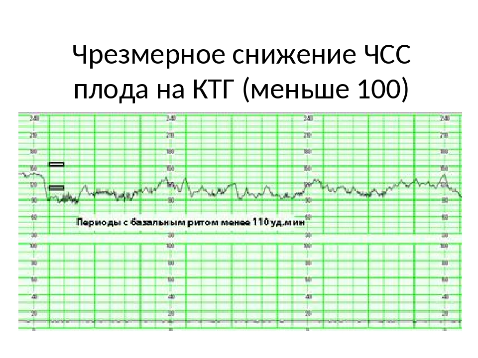 36 неделя сердцебиение