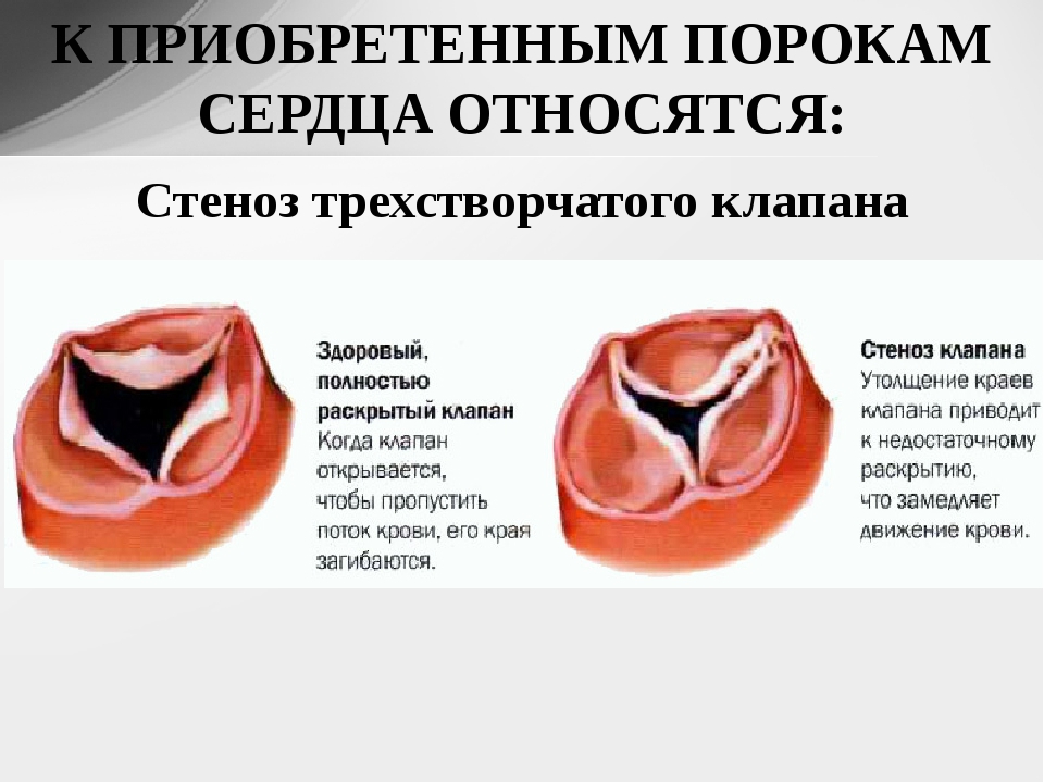 Порок сердца это. Пороки сердца стеноз и недостаточность. Трикуспидальный клапан сердца пороки. Порок трехстворчатого клапана сердца. Приобретенные пороки аортального клапана.