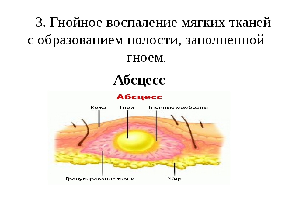 Образование полости. Гнойное воспаление абсцесс. Гнойное воспаление мягких тканей с образованием.