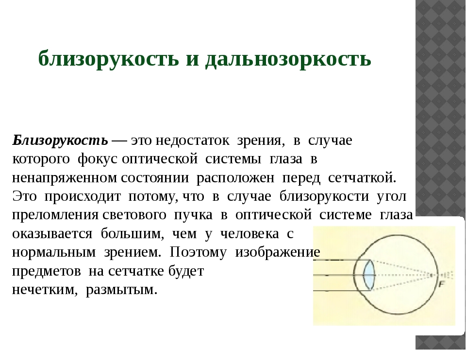 Изображение перед сетчаткой это