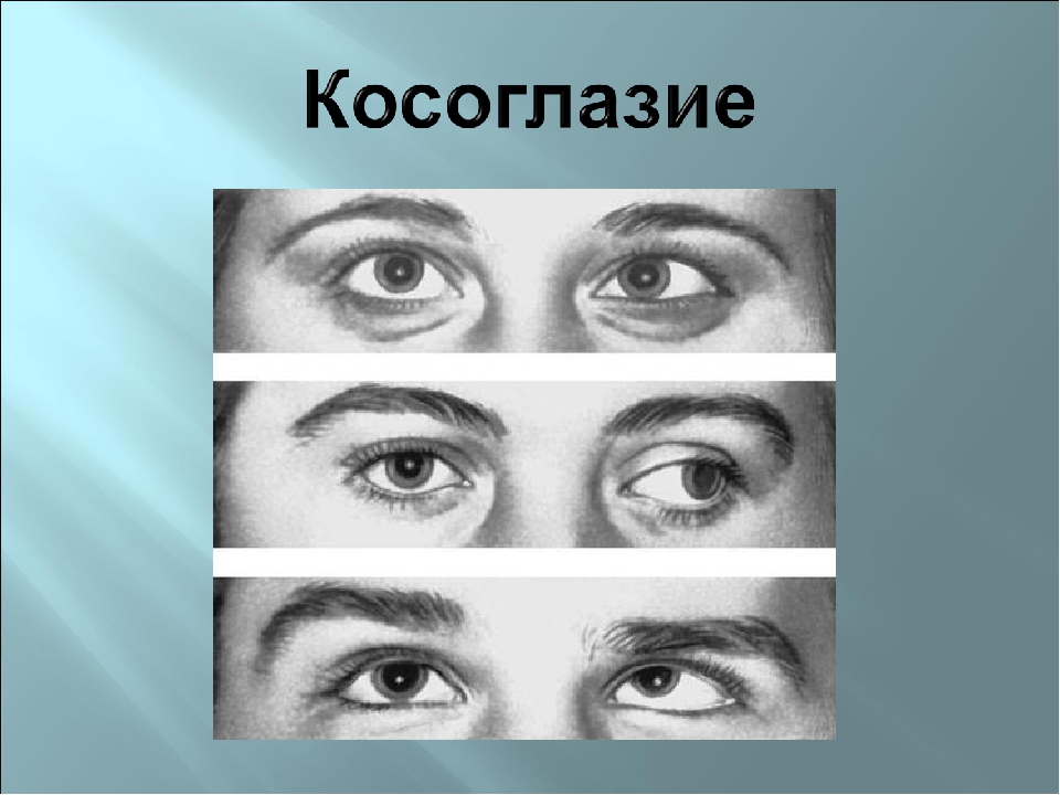 Угол косоглазия по гиршбергу картинки