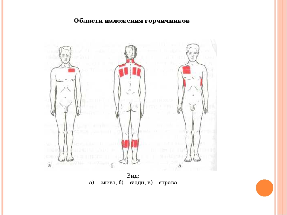 Место постановки. Горчичники схема наложения. Схема постановки горчичников при кашле. Места постановки горчичников. Постановка горчичников места постановки.