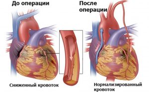 Аортокоронарное шунтирование