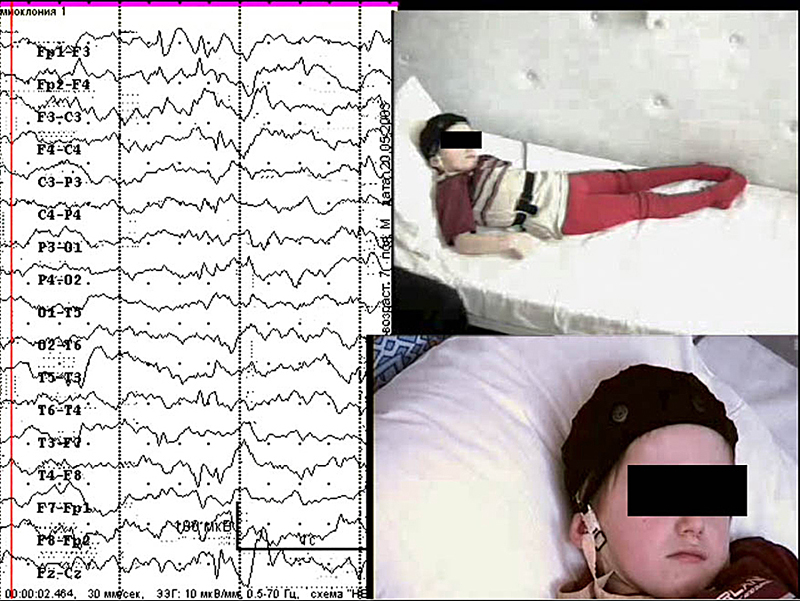Ээг видеомониторинг сна. ЭЭГ ВМ дневного сна. ЭЭГ головного мозга видеомониторинг. Видеомониторинг ЭЭГ 4 часовой. Суточный видеомониторинг ЭЭГ.