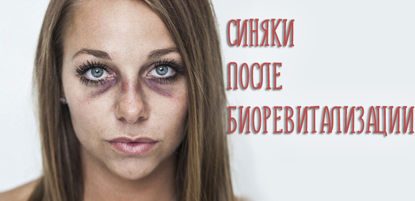 Синяки после биоревитализации – как лечить и быстро убрать проблему?