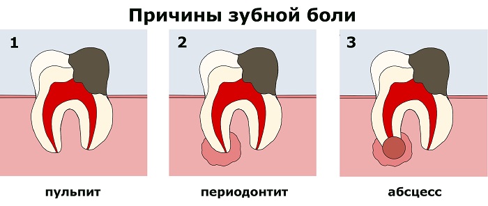 Болит зуб при надавливании. Зуб болит от холодного. Ноющая пульсирующая боль в зубе.