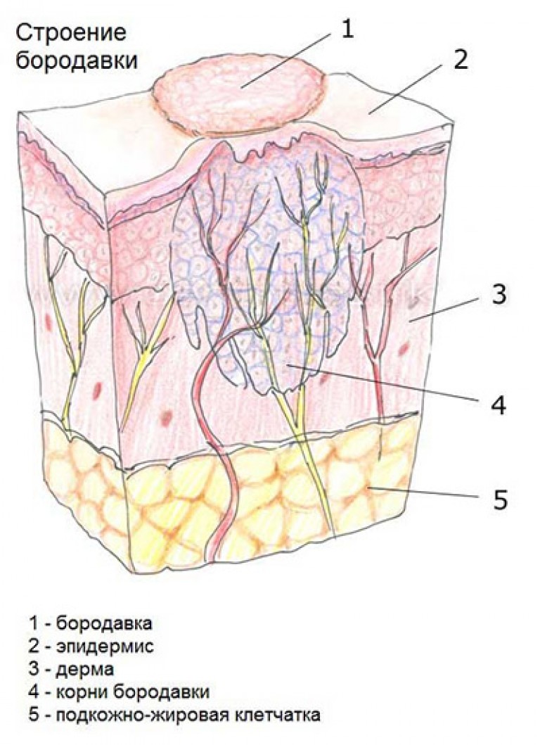 Структура подошвенной бородавки