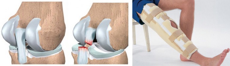 Разрыв связок операция. Что такое мениск коленного сустава гипс. Растяжение мениска коленного сустава. Спейсер коленного сустава.