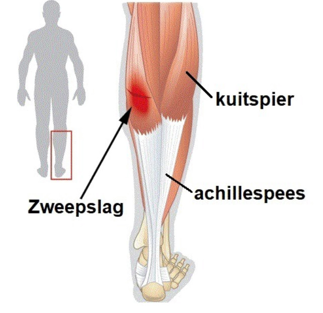 Почему икроножная мышца. Gastrocnemius мышца medial. Шишка на икроножной мышце. Уплотнение в икроножной мышце. Болит икроножная мышца ноги.