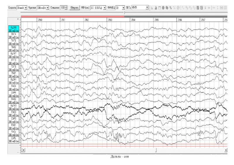 Мониторинг сна. ЭЭГ сна f8 красный. Видеомониторинг ЭЭГ ночной расшифровка. ЭЭГ 3х часовой мониторинг Красноярск. ЭЭГ ребенку 2 года.