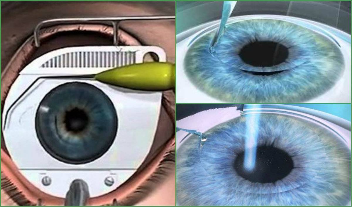 Зрение 2 операция. Лепто ласик. Лазерная рефракционная кератопластика (метод LASIK при миопии).